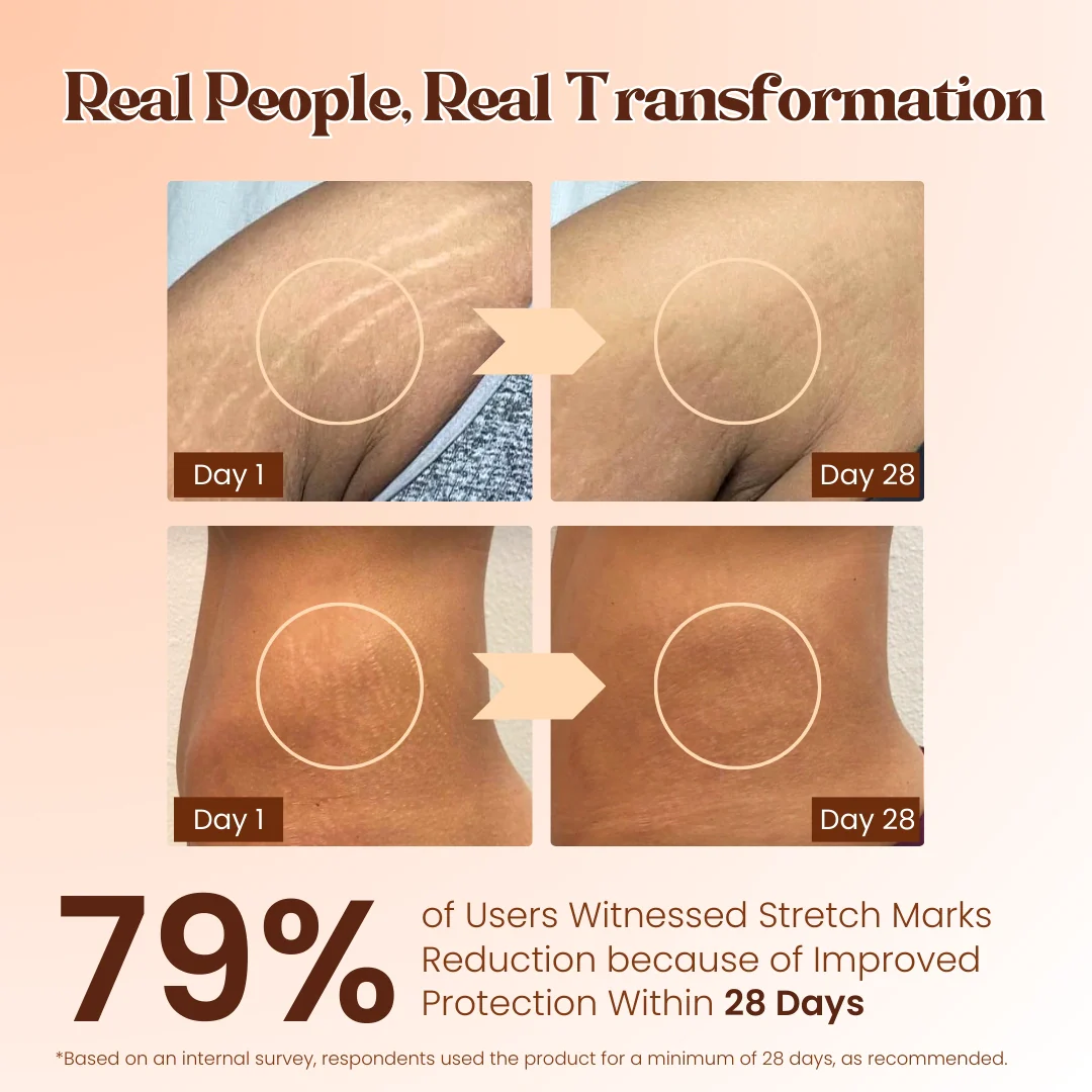 Stretch Mark Repair Combo – Day and Night Care for Visible Results - Image 5